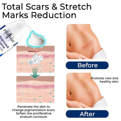 Gel de silicone avancé pour l'élimination des cicatrices