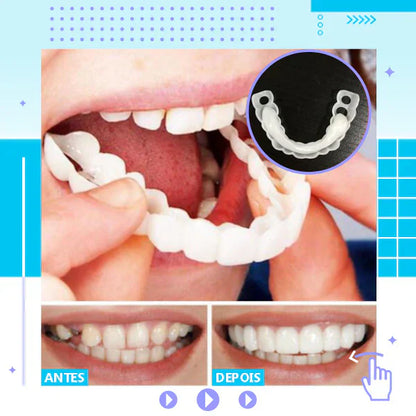 Snap On Smile – Prothèse dentaire-50% de réduction