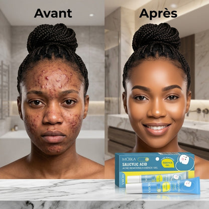 Gel Anti-Acné Traitant Rapide et Efficace pour Peau Lisse. Resserrer les pores, éliminer les cicatrices et taches  ✅ Résultats visibles dès les premières applications