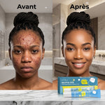 Charger l'image dans la galerie, Gel Anti-Acné Traitant Rapide et Efficace pour Peau Lisse. Resserrer les pores, éliminer les cicatrices et taches  ✅ Résultats visibles dès les premières applications
